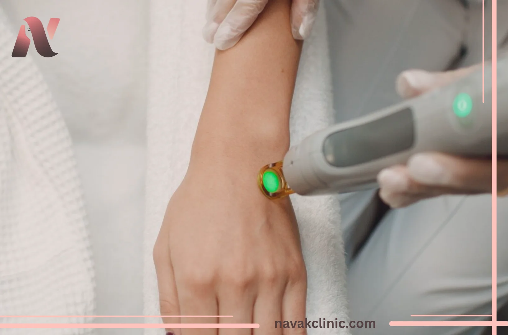 لیزر شاتی برای رفع موهای زائد