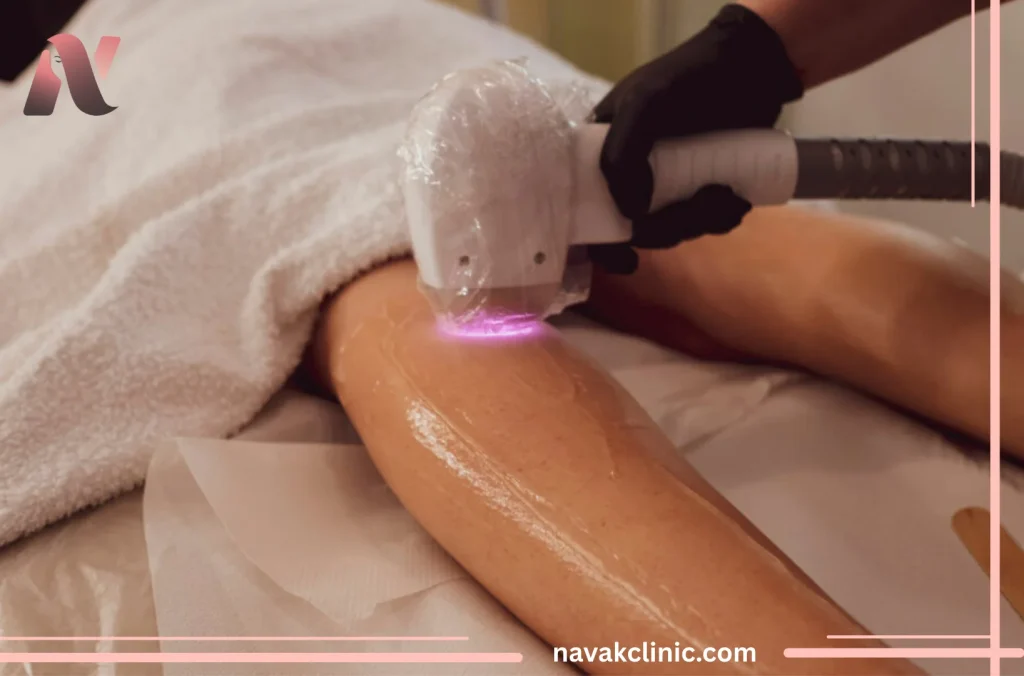 معرفی لیزر رولی