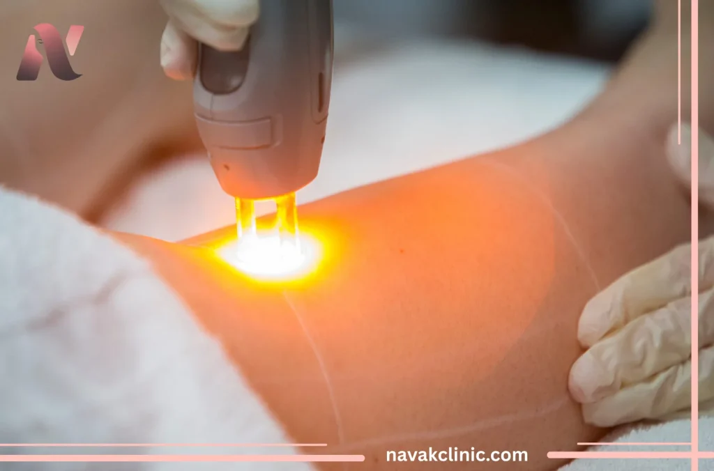 نکات ضروری قبل لیزر موهای زائد